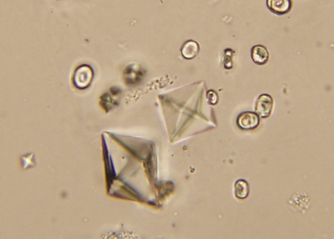 calcium oxalate mono and dihydrate crystals in urine sediment