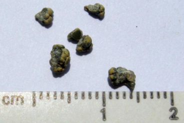 dha urinary stones next to rule for reference
