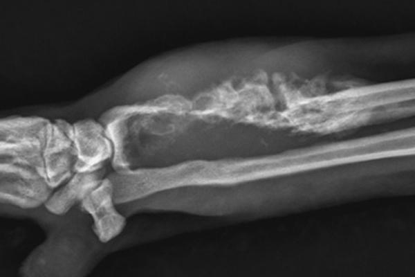 xray of a bone tumor