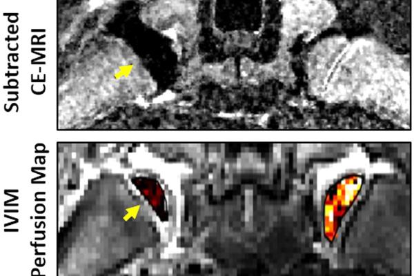 Femoral head MRI image