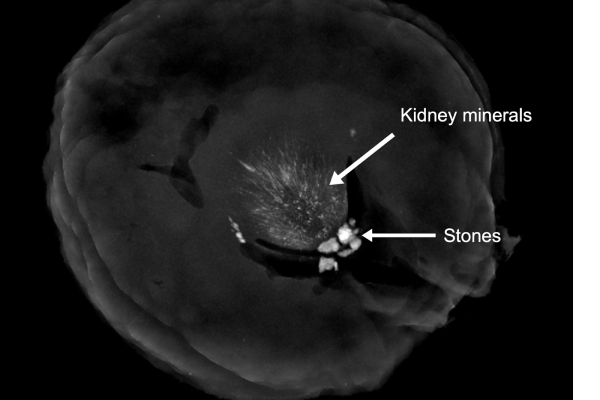 Cross-section of kidney with stones and mineralization